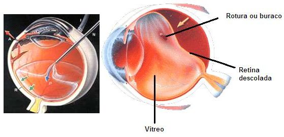 retina e vítreo_cirurgia