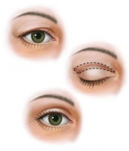 Eyelid-surgery-Illustration-Prasad-Cosmetic-e1442507786910