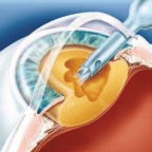 Cirurgia-Catarata-01