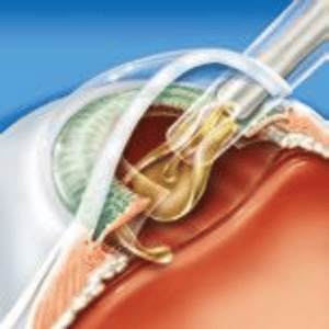Cirurgia-Catarata-02