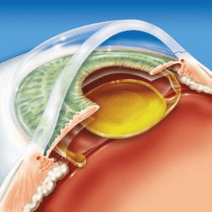 Cirurgia-Catarata-03